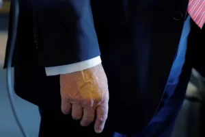 Diagnostican a Trump con insuficiencia venosa crónica tras hinchazón en las piernas