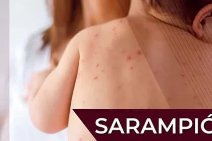 Sarampión, más contagioso que la COVID-19