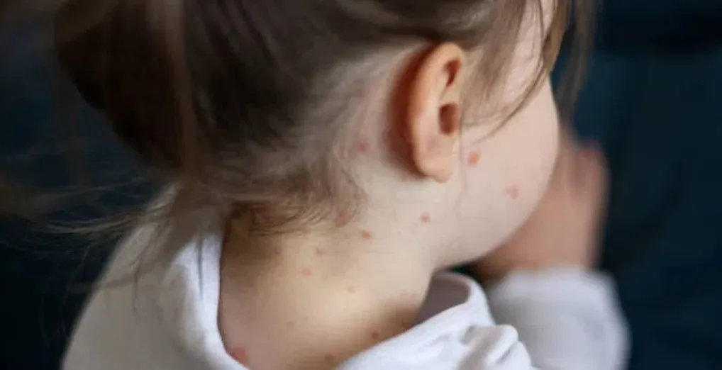 ¿Cuántos días tardan en aparecer los síntomas del sarampión