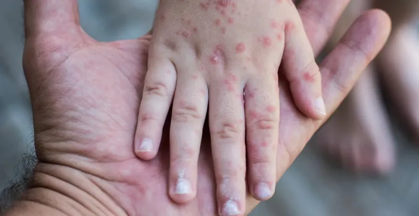 CDMX confirma segunda muerte por sarampión; suman 576 casos acumulados