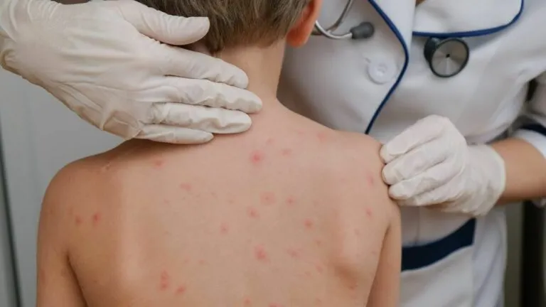 Alerta por el avance del sarampión en Reino Unido, confirman dos muertes y más de cien casos recientes